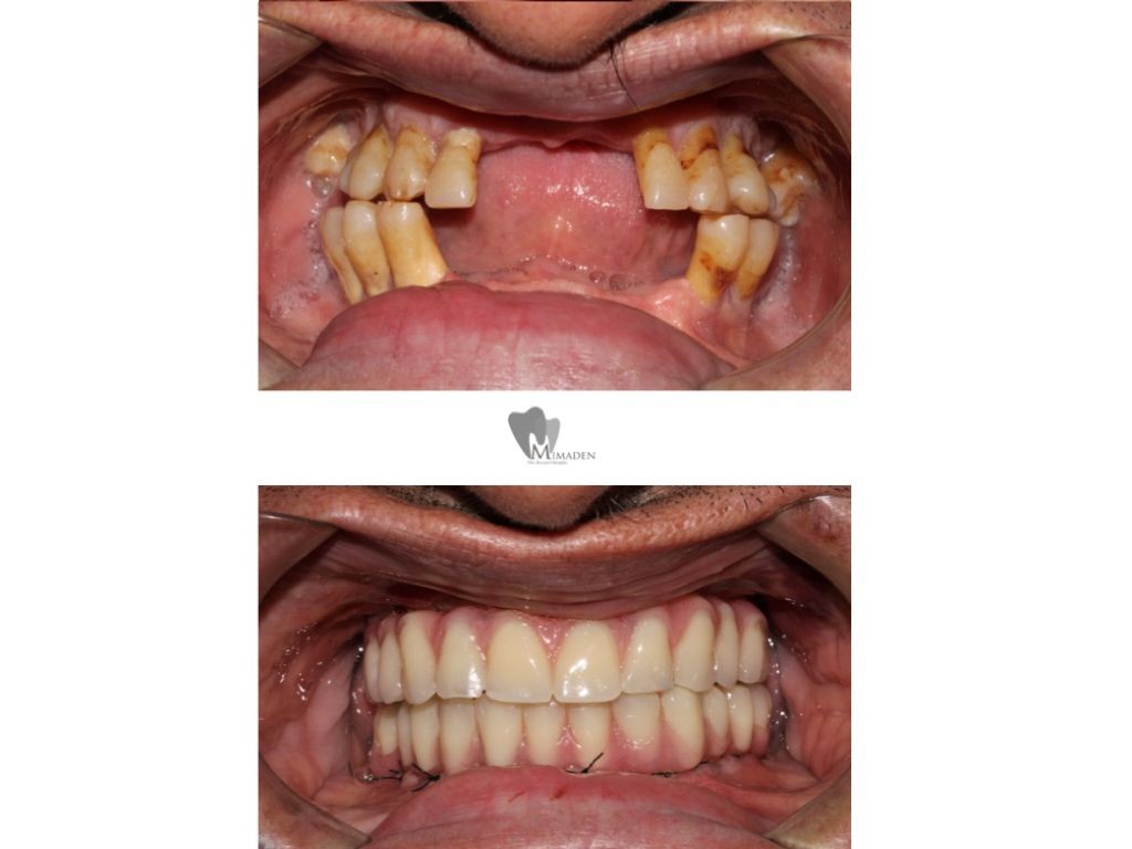 implantes dentales de carga inmediata