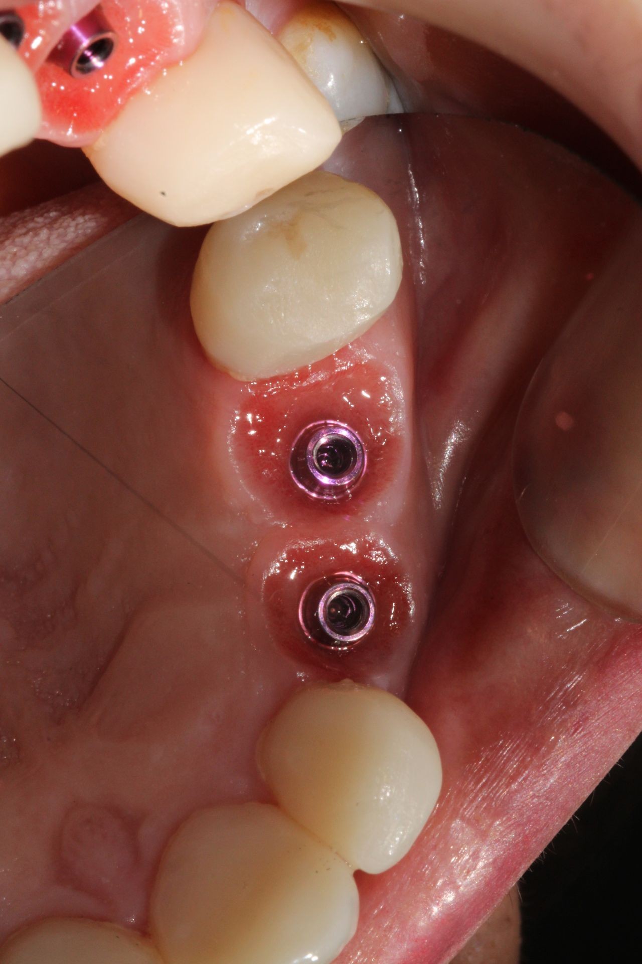 extracciones muelas del jucio, extracciones dientes rotos, implantes